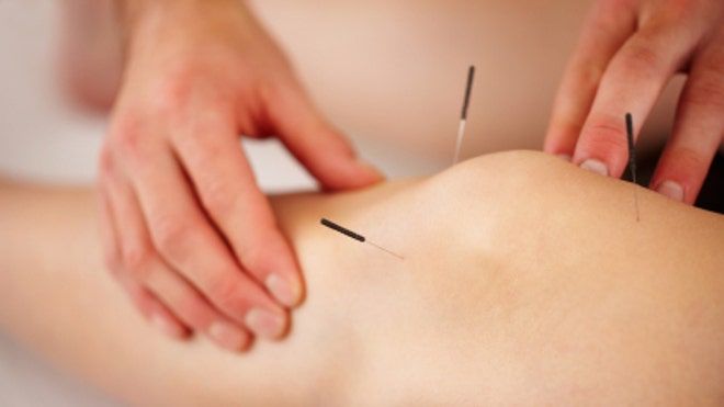 needle acupuncture